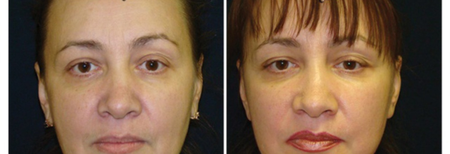 Фейслифтинг