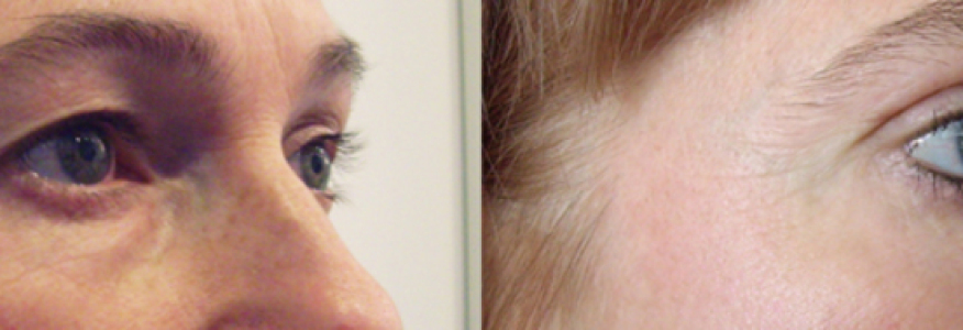 Блефаропластика 