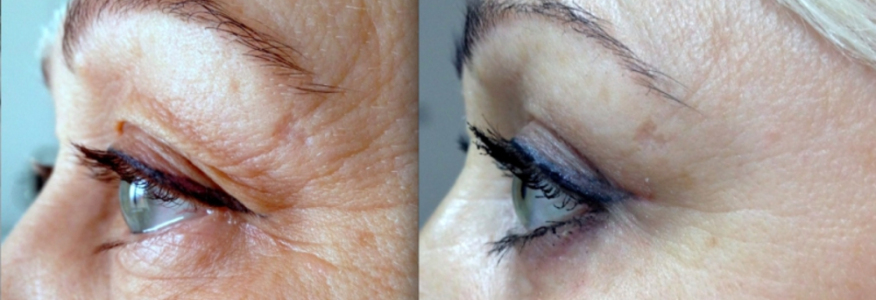 Блефаропластика 