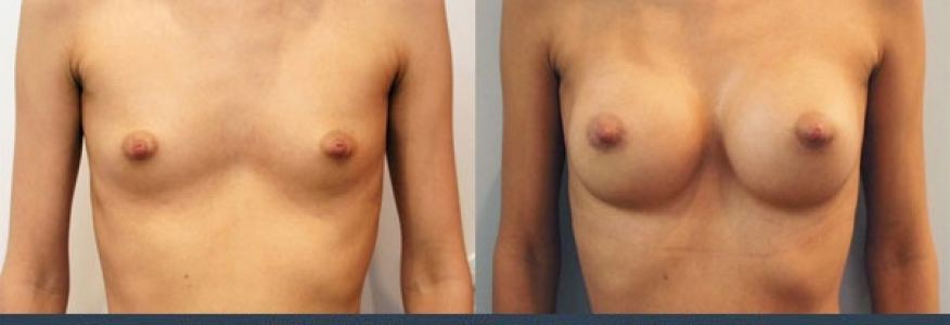 Увеличение груди