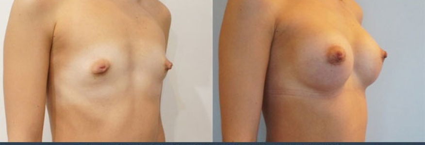 Увеличение груди