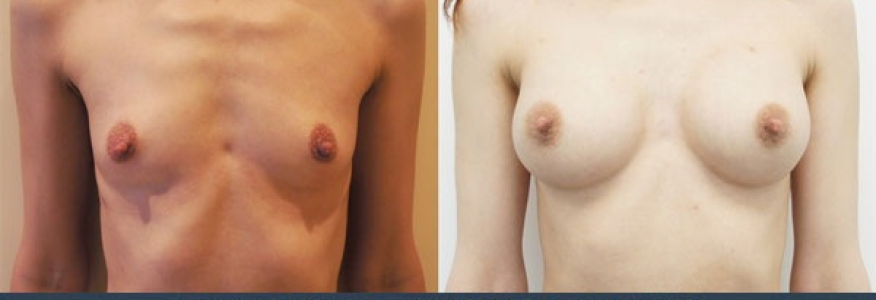 Увеличение груди