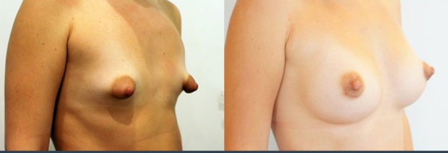 Увеличение груди