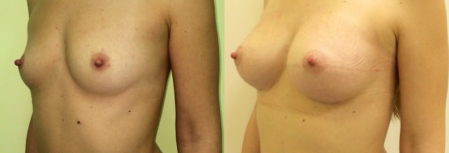 Увеличение груди