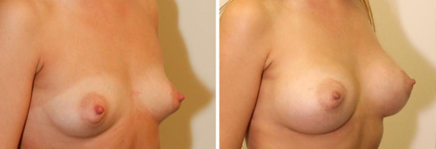 Увеличение груди