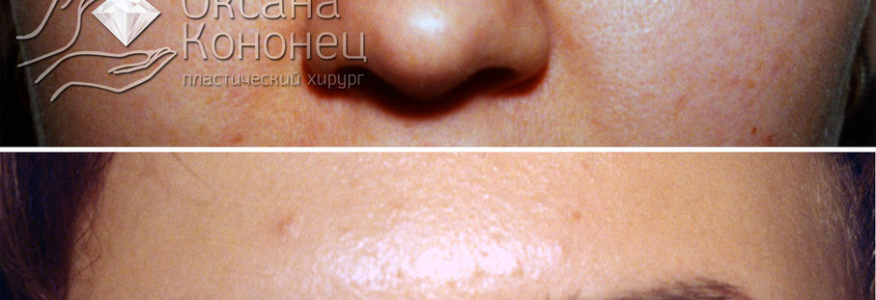 БЛЕФАРОПЛАСТИКА ВЕРХНИХ ВЕК