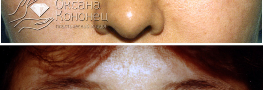 БЛЕФАРОПЛАСТИКА ВЕРХНИХ ВЕК С ФОРМИРОВАНИЕМ СКЛАДКИ ПРИ ОРИЕНТАЛЬНОМ РАЗРЕЗЕ ГЛАЗ