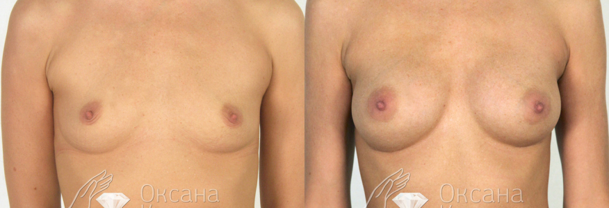 УВЕЛИЧЕНИЕ ГРУДИ