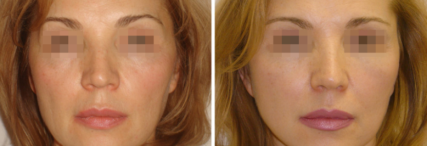 Фейслифтинг