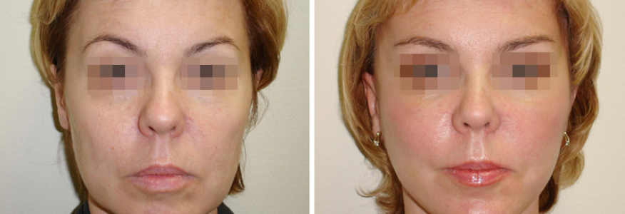 Фейслифтинг