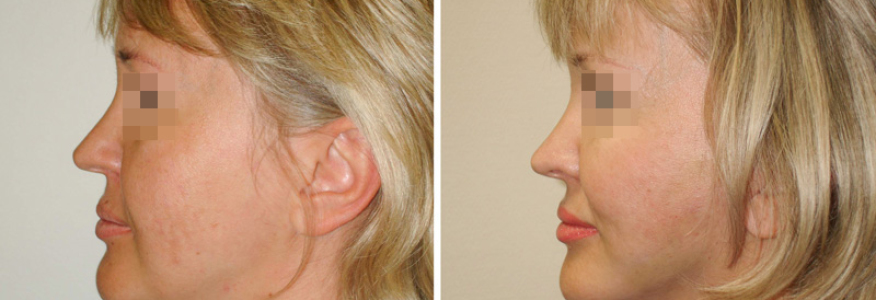 Фейслифтинг