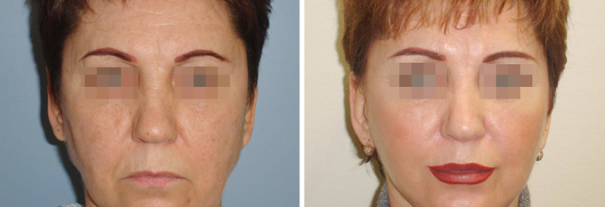 Фейслифтинг