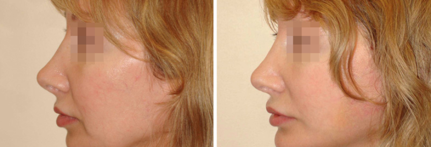 Фейслифтинг