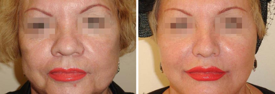 Фейслифтинг