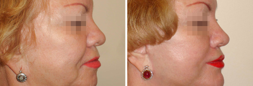 Фейслифтинг