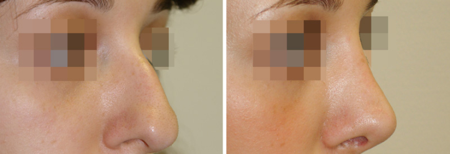 Ринопластика