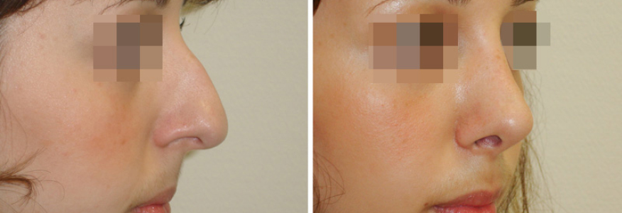 Ринопластика