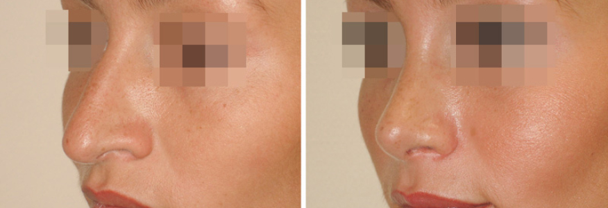 Ринопластика