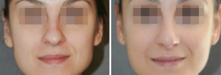 Ринопластика