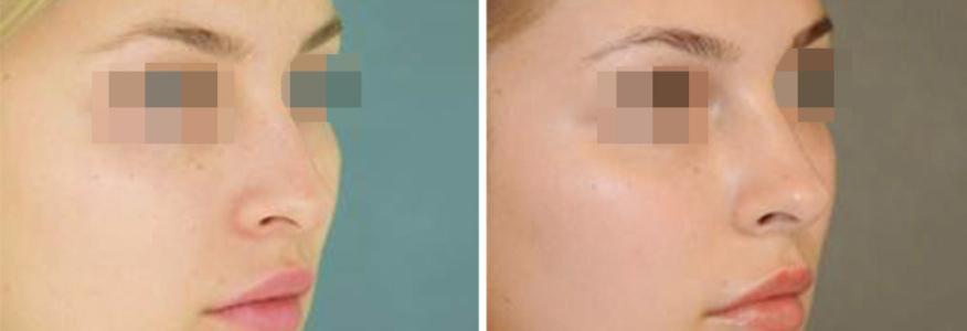 Ринопластика