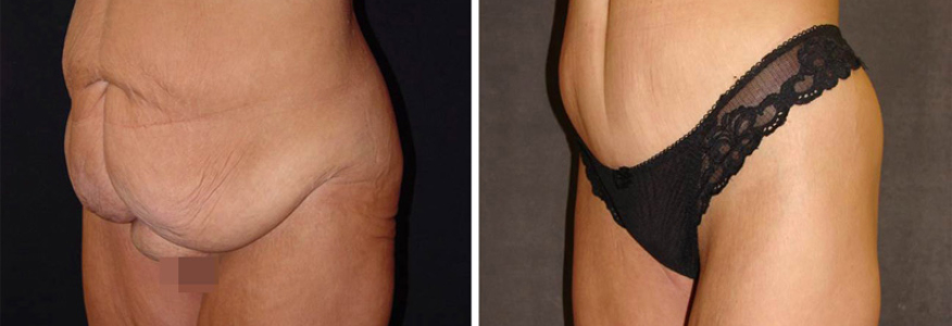 Абдоминопластика