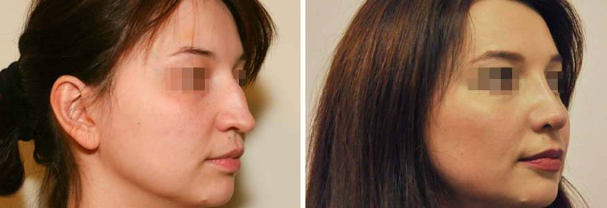 Ринопластика 