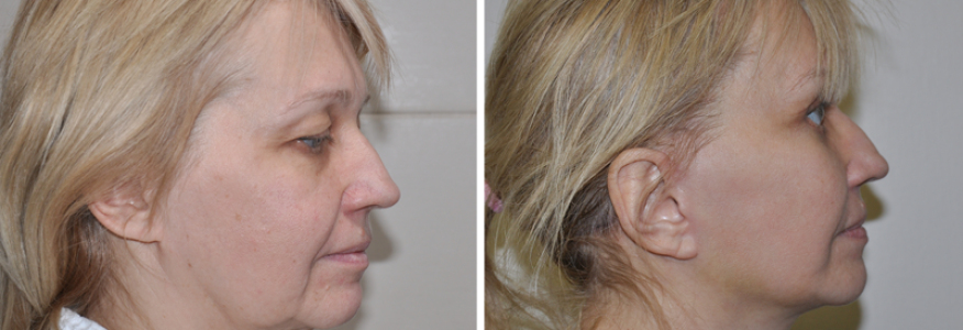 Фейслифтинг