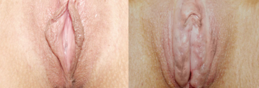 Лабиопластика, фото сразу после операции