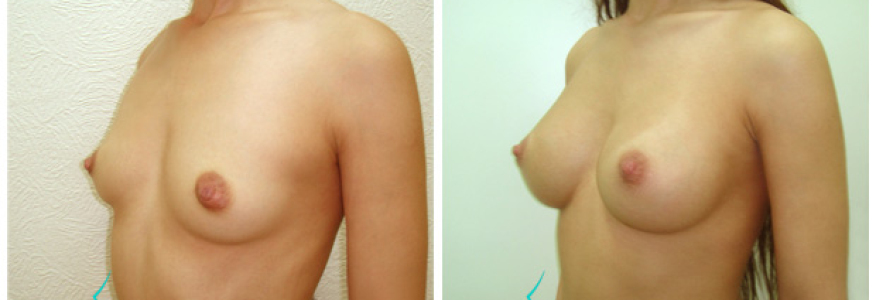 Увеличение груди