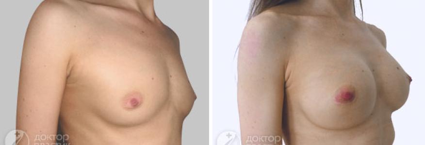Увеличение груди