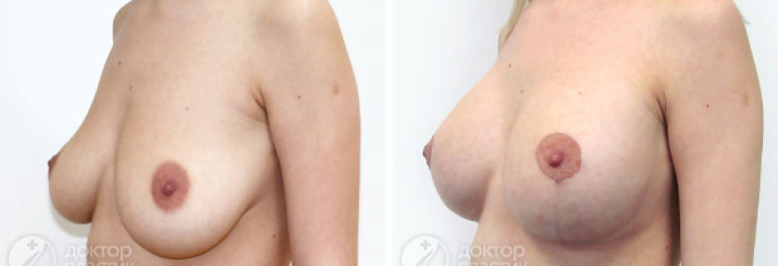 Подтяжка с увеличением