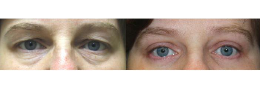 Блефаропластика