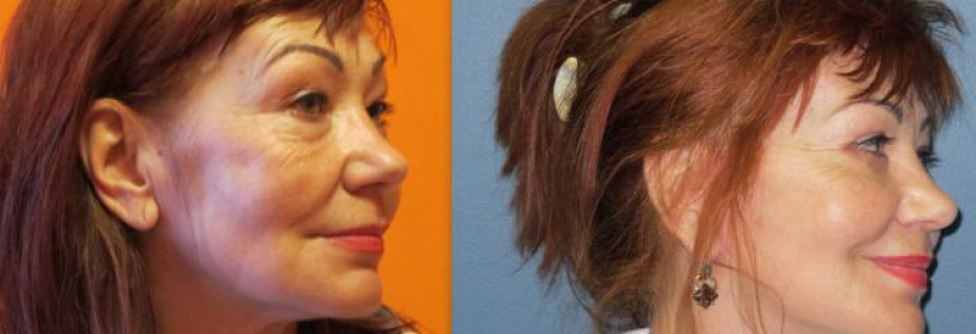 Круговая блефаропластика+ macs лифтинг