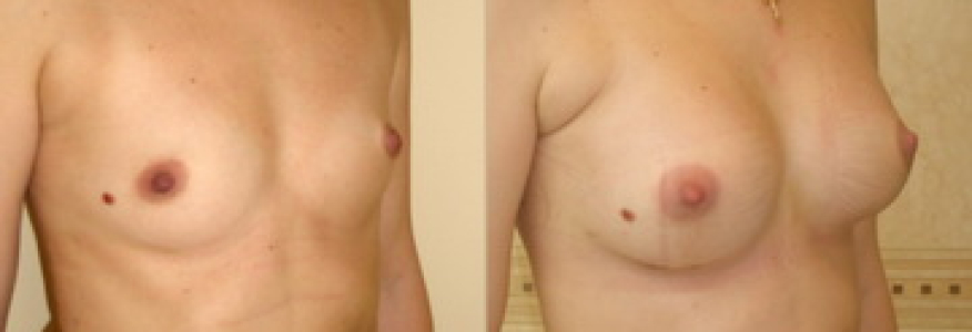 Увеличение груди