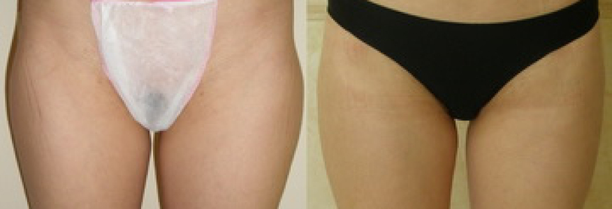 Липосакция бедер