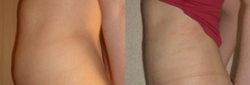 Липосакция живота