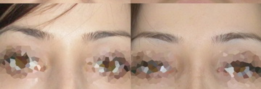 Ринопластика