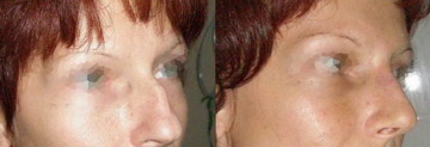 Ринопластика