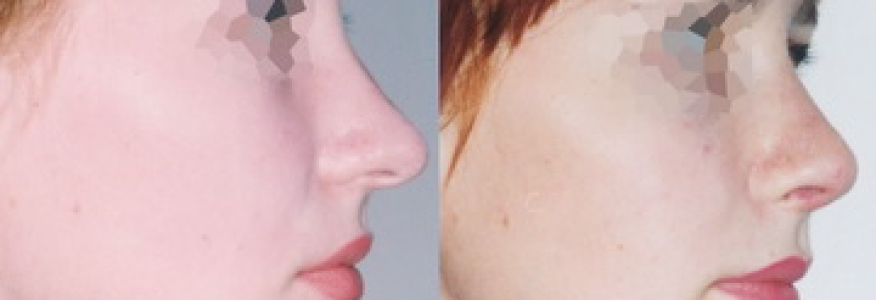 Ринопластика