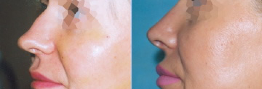 Ринопластика