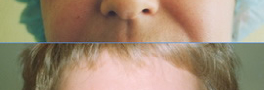 Блефаропластика