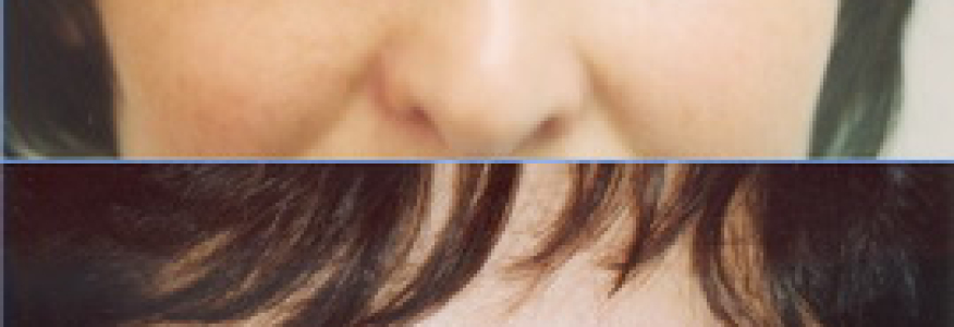 Блефаропластика