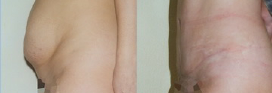 Абдоминопластика