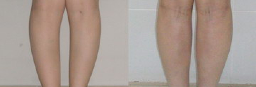 Круропластика - исправление кривизны ног