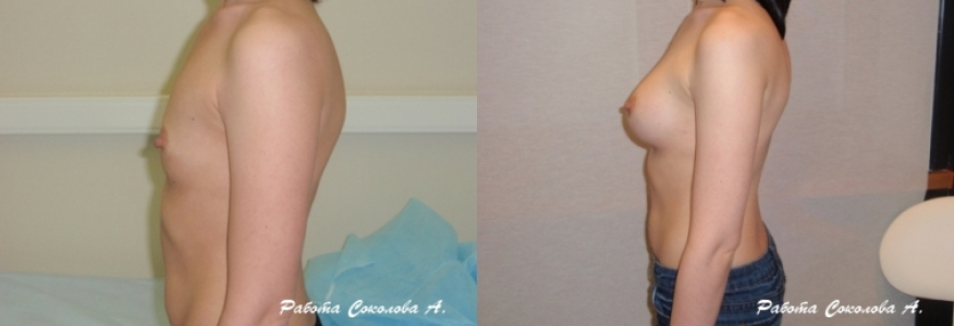 Увеличение груди