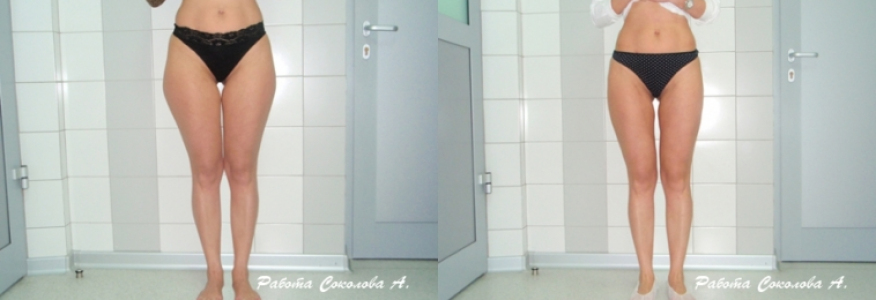 Липосакция