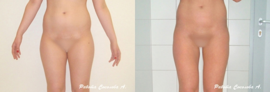 Липосакция