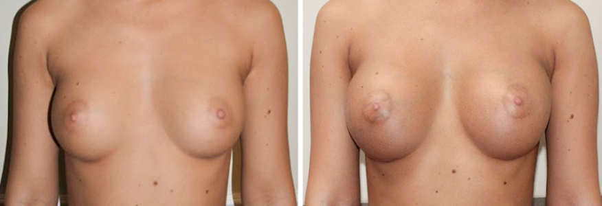 Увеличение груди