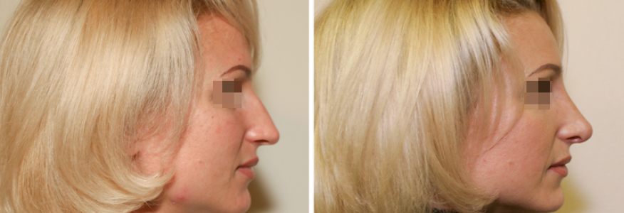 Ринопластика 