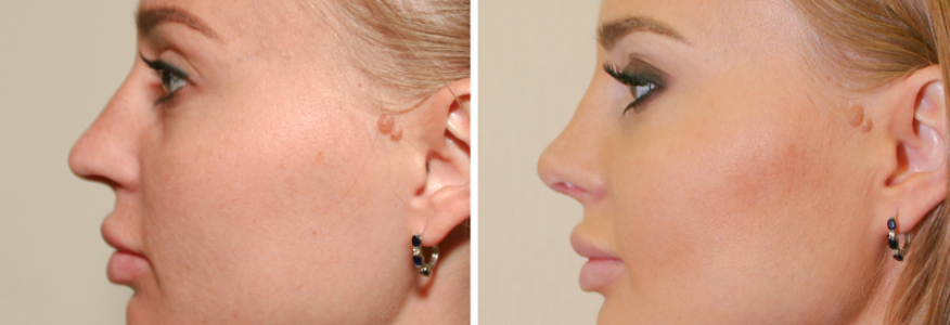 Ринопластика 